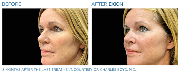 EXION Face Treatment in San Antonio, TX Before / After 1