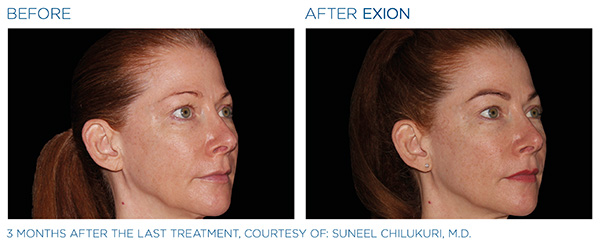 EXION Face Treatment in San Antonio, TX Before / After 2