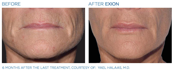 EXION Face Treatment in San Antonio, TX Before / After 3